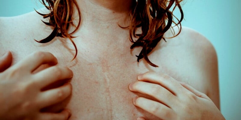 You are currently viewing Mycose du sein : comment la reconnaître et la traiter ?